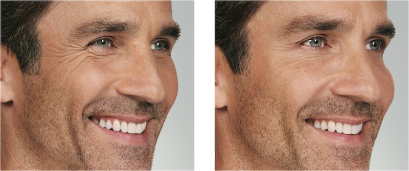 Botox before and after