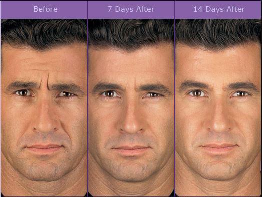 Botox