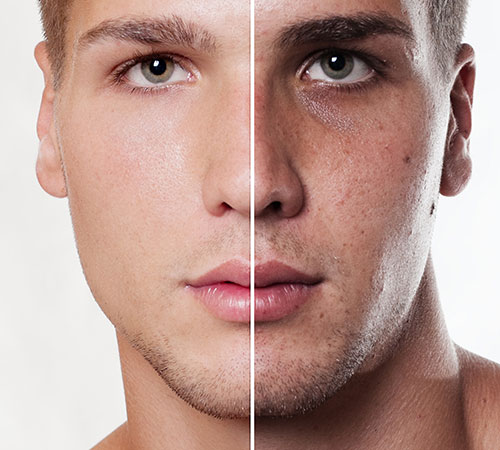 Deep Cleansing Facials with Extraction before and after