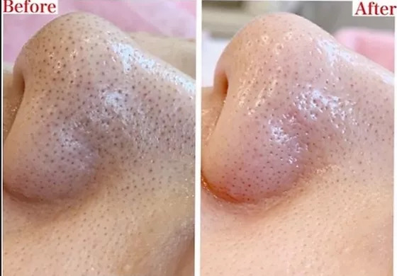 Deep Cleansing Facials with Extraction procedure
