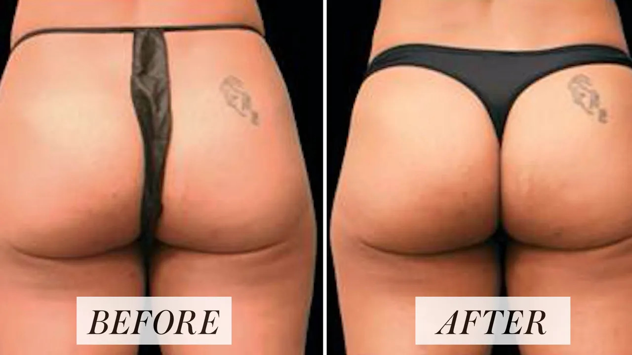 EMSculpt before and after