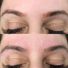 Eyebrow Laser Tattoo Removal before and after