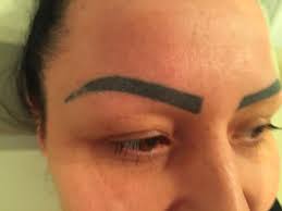 Eyebrow Laser Tattoo Removal procedure