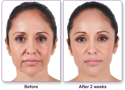 Filler before and after