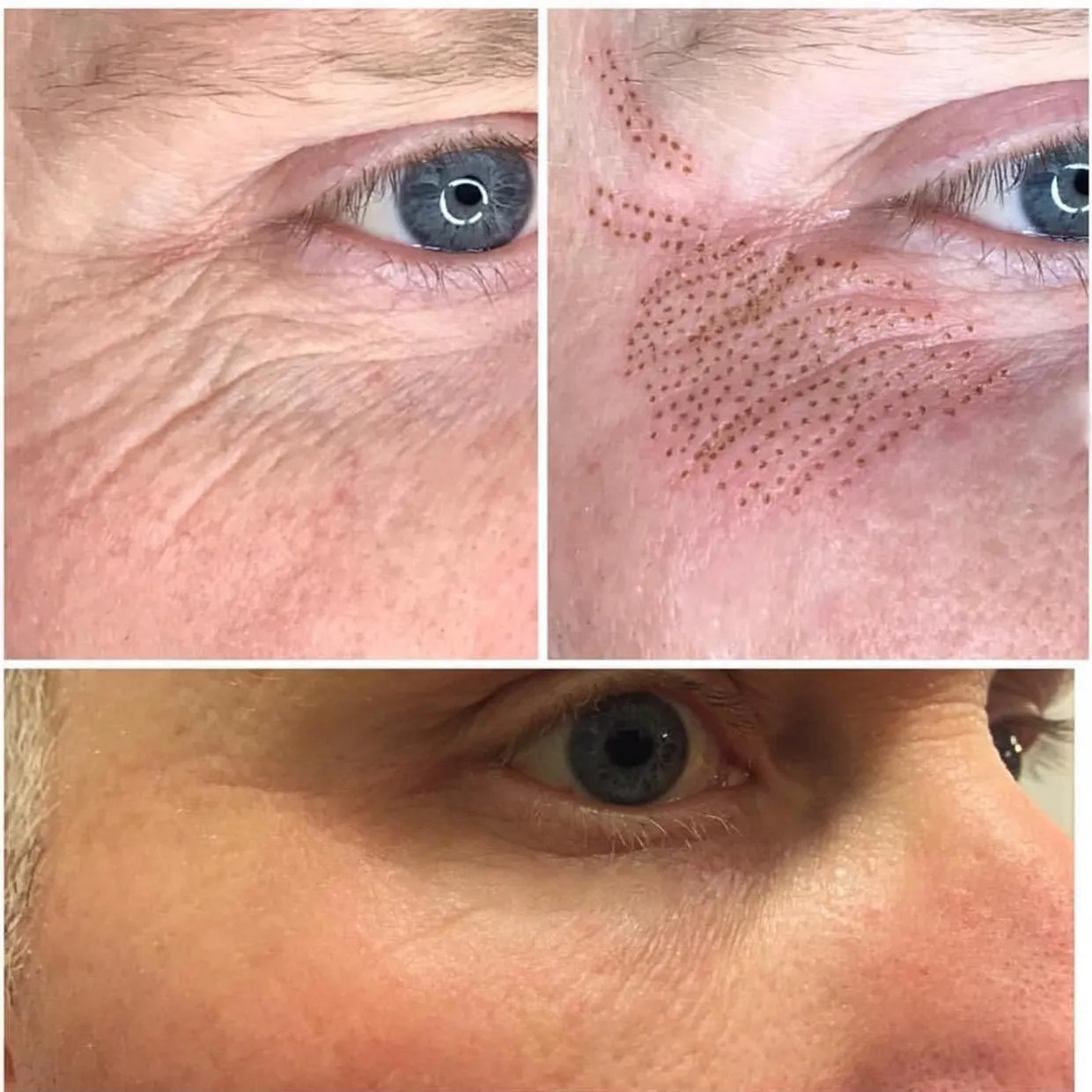 Fibroblast Plasma before and after