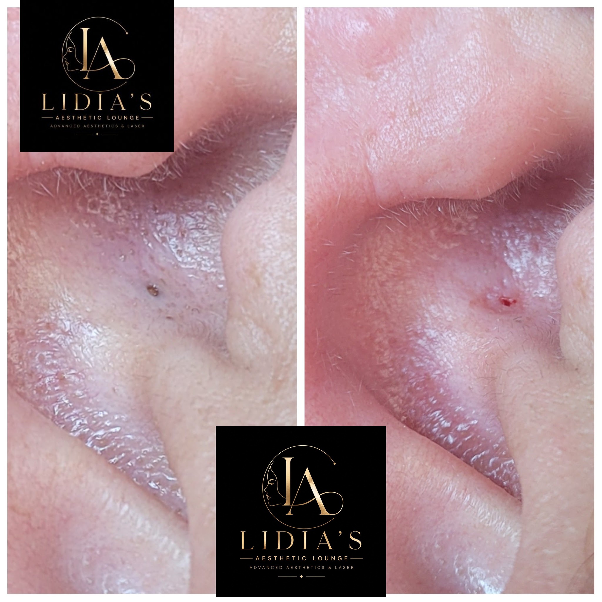 Blackhead Extraction Results