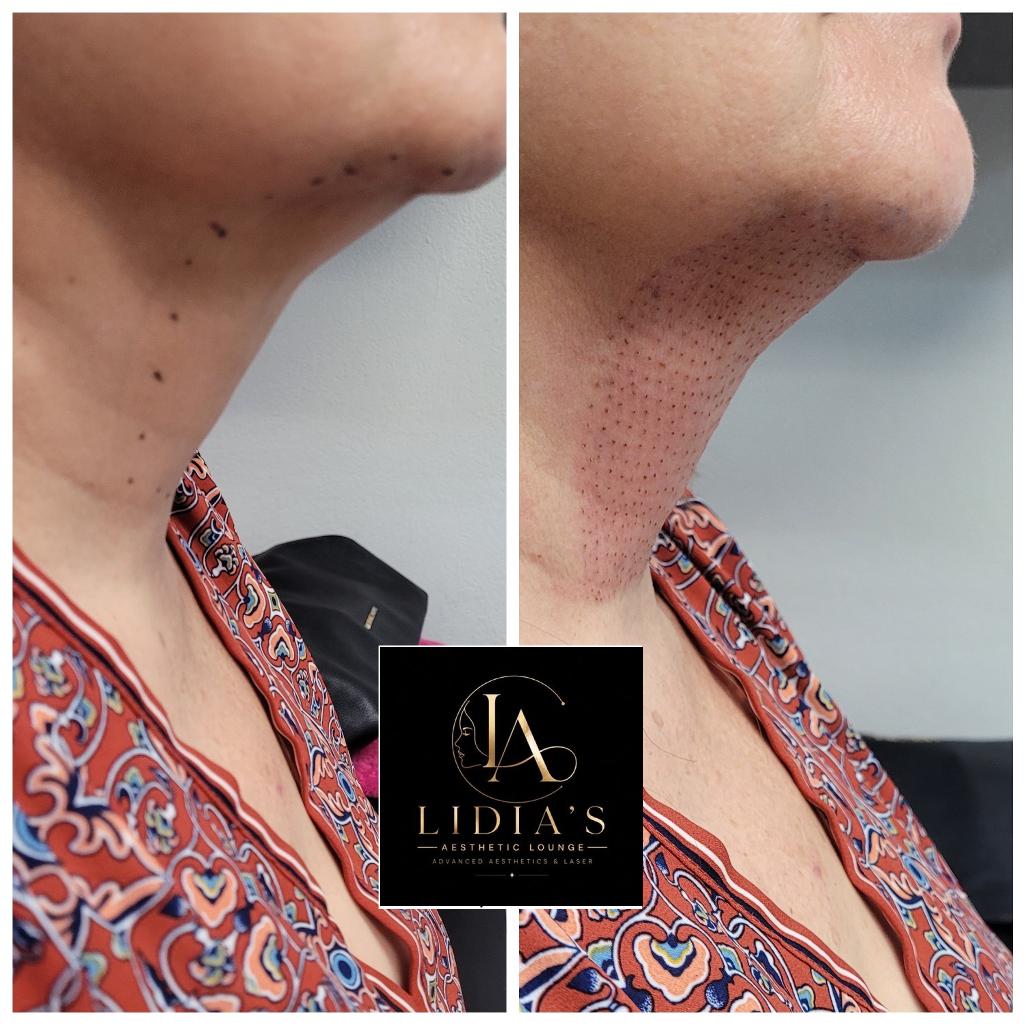 Fibroblast Plasma Results