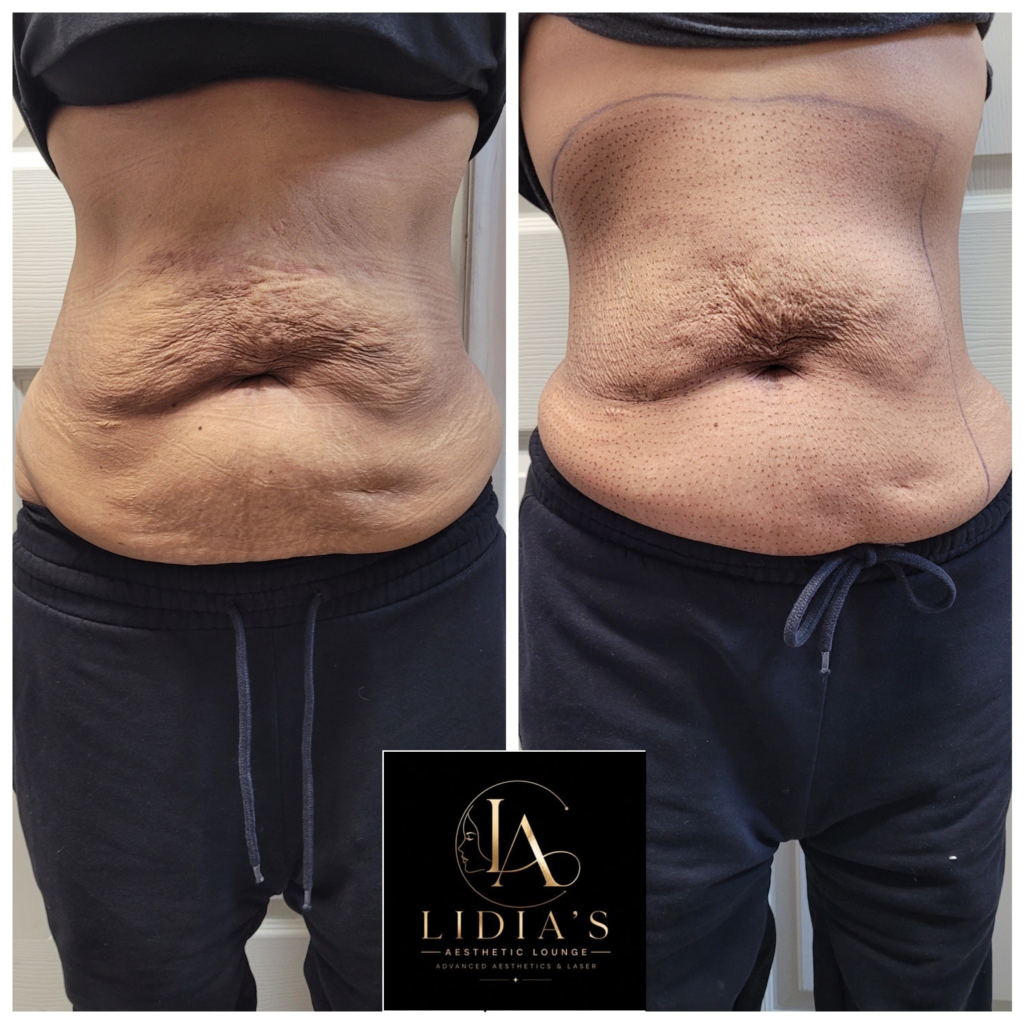 Fibroblast Plasma Results