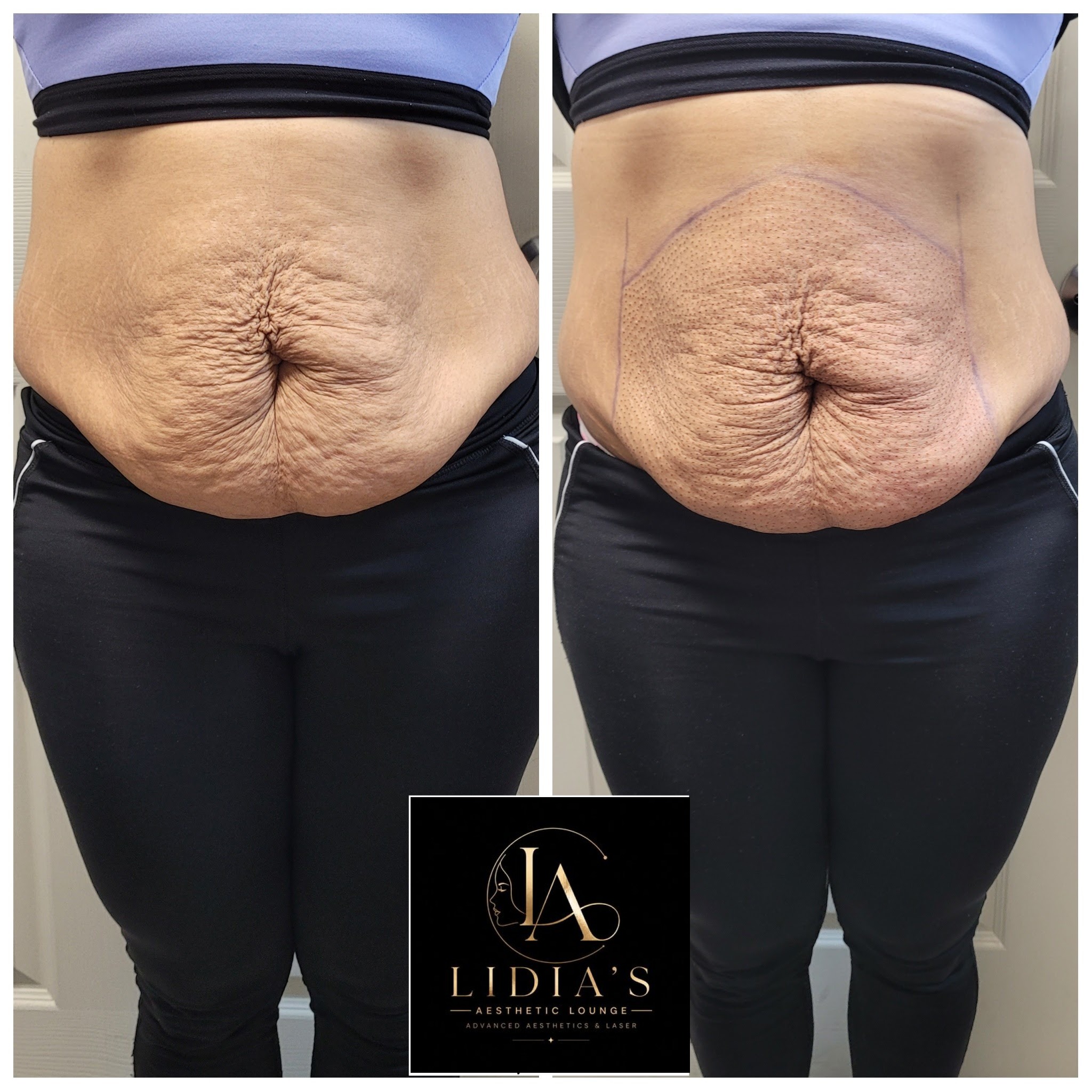 Fibroblast Plasma Results
