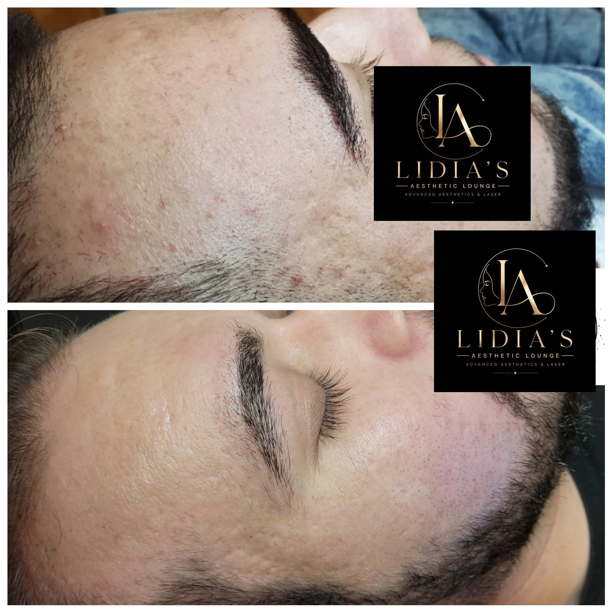 Fibroblast Plasma Results