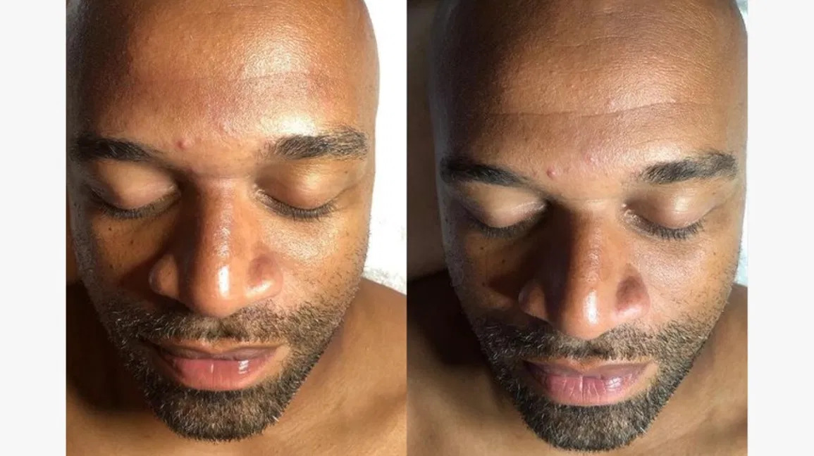 Hydra Facial before and after