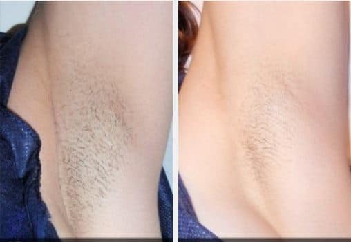 Laser Hair Removal before and after