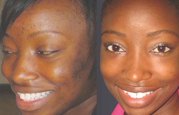 Skin Brightening & Lightening before and after