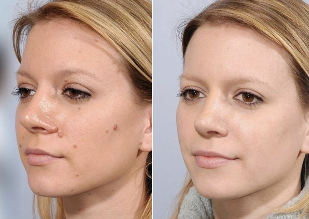 Skin Tag Removal before and after
