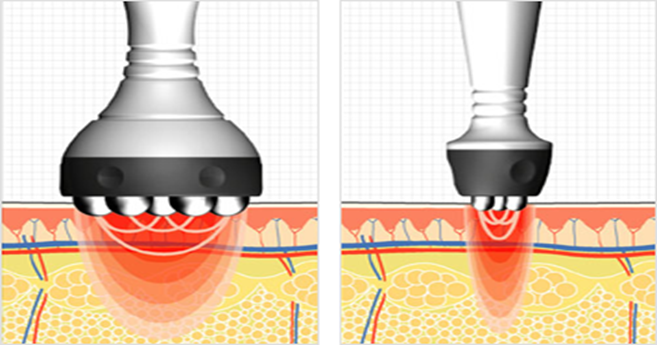 Ultrasonic Cavitation procedure